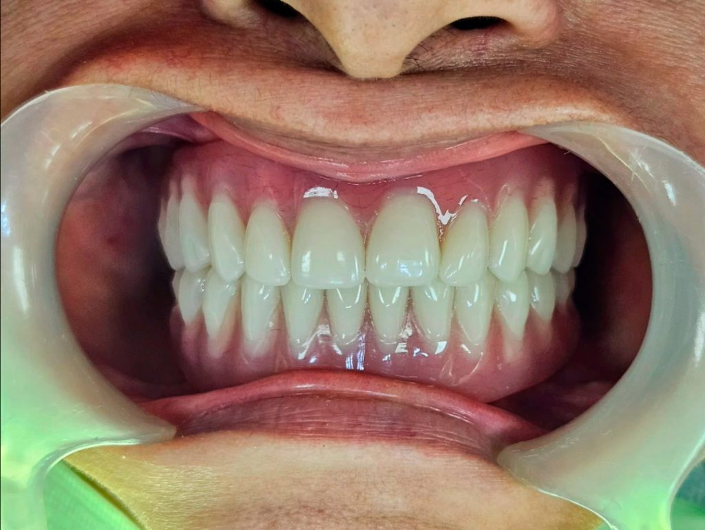 All on four realizado por el Dr Ivan Lindo