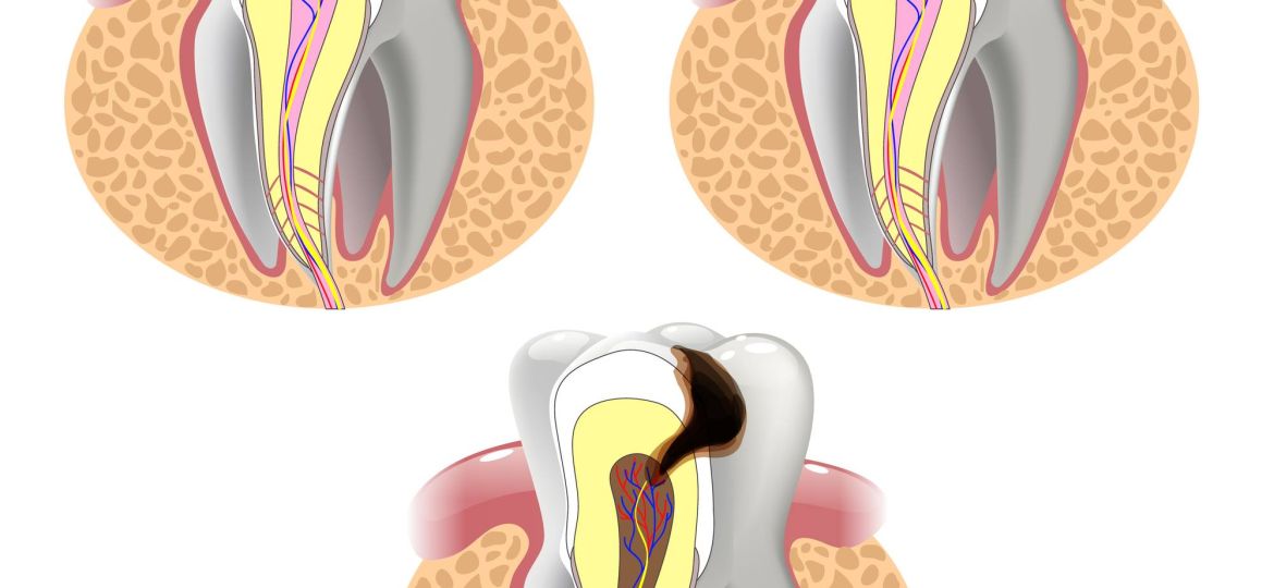 Dental Implant Solutions