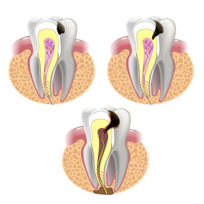 Dental Implant Solutions