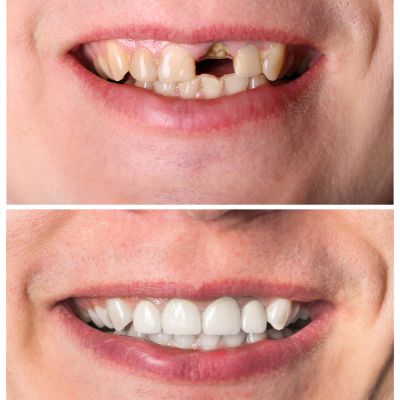 Incisive tooth restoration before and after treatment