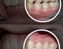 after and before orthodontic treatment