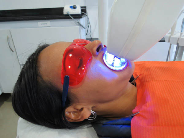 Teeth Whitenng at Dr. Ivan Lindo