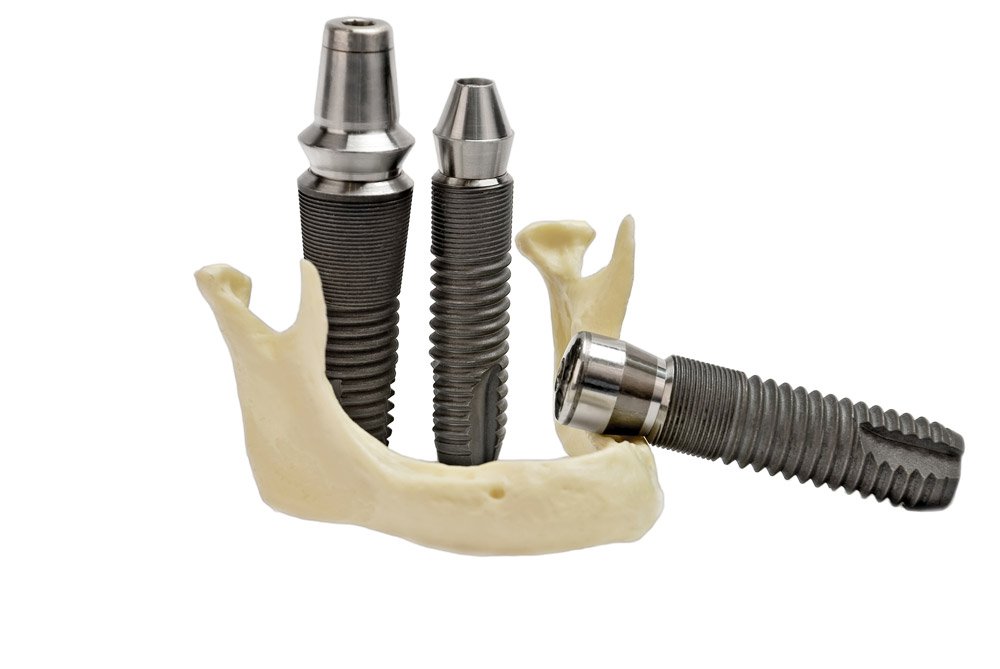 Implantes Dentales a Buen Precio