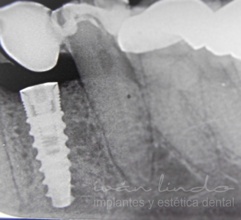 implantes-dentales-caso-18