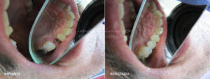 Dental implant solutions