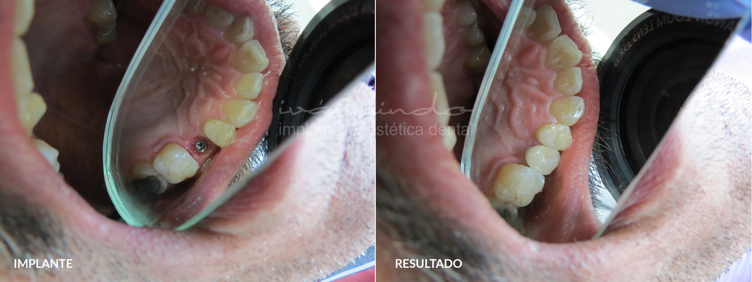 implantes-dentales-caso-34