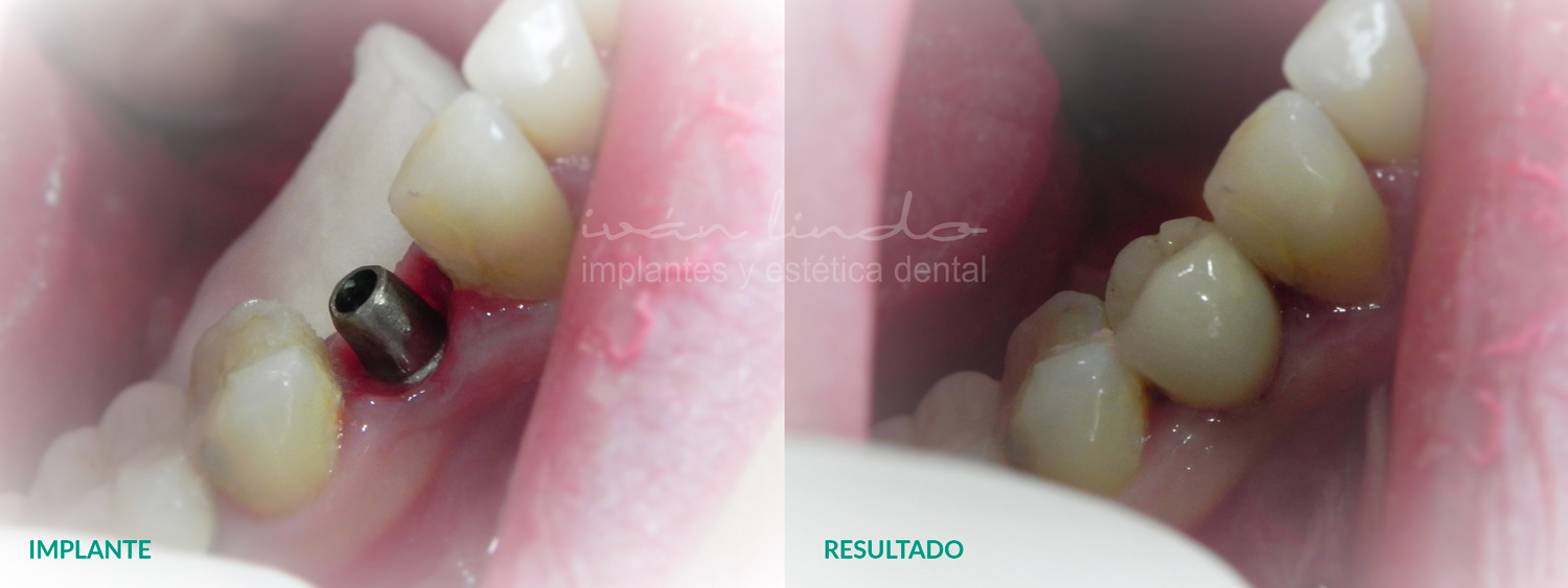 implantes-dentales-caso-63