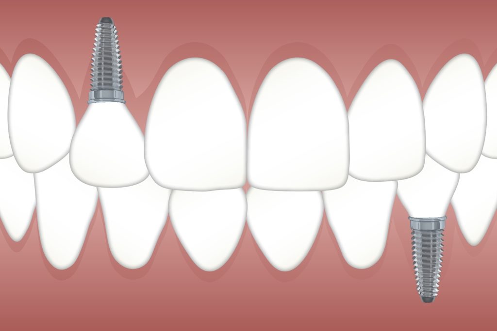 Dental Implant Solution