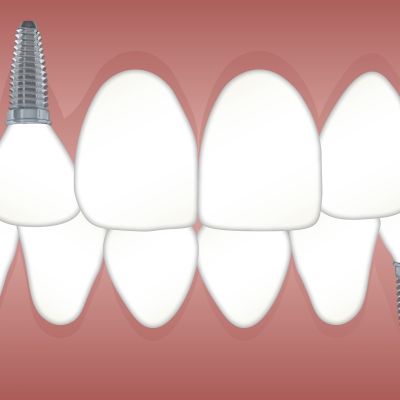 Dental Implant Solution