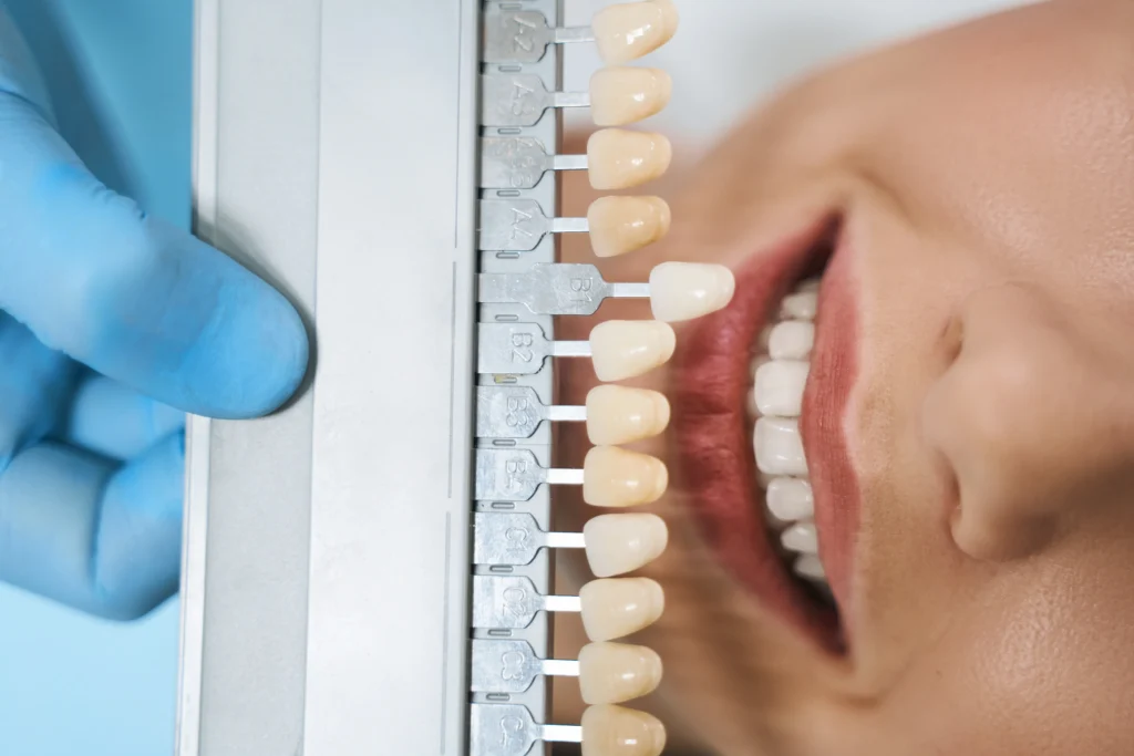 Blanqueamiento dental con implantes