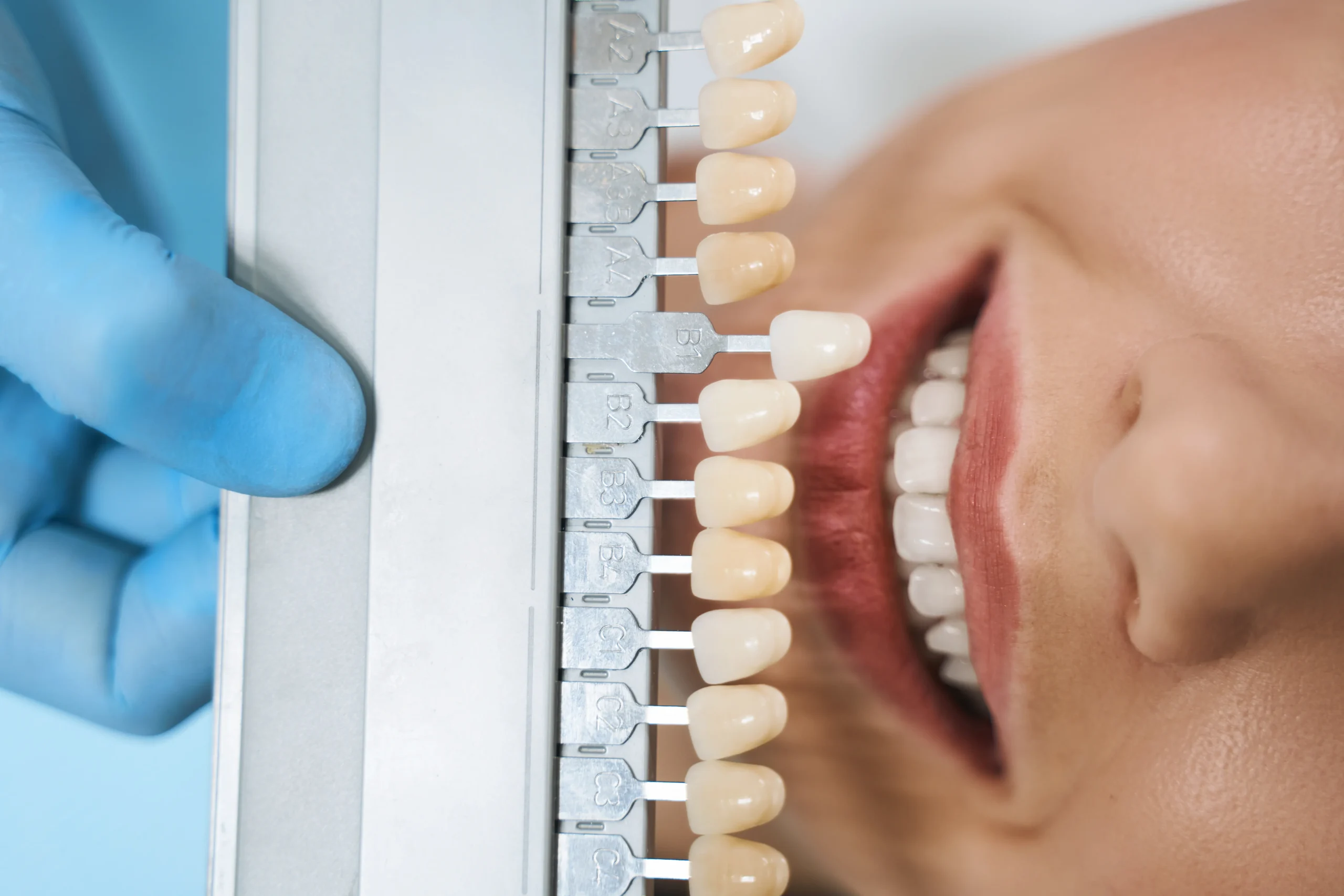 Blanqueamiento dental con implantes