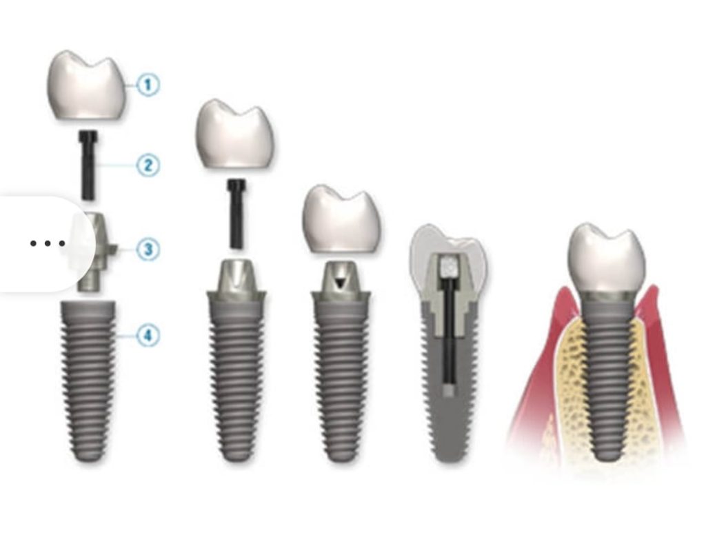 implantes dentales